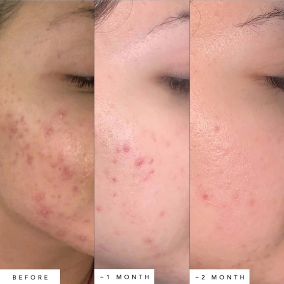 NEW Herbivore Lapis Facil Oil Soothing Facial Oil Full size 1.7fl oz Acne Combo - Picture 4 of 6